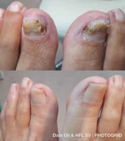 De Nummer 1 Tegen Schimmelnagels! - HFL - Laboratories - Solution Spray - 50ml + Dadi'Oil Nagelriem Olie - 3.75ml - Kalknagel Spray - Schimmelnagel Spray - Nagelriem Olie - Nagelverzorging -Verzorgingsproducten 1065x1200