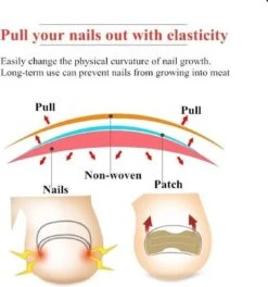 Merkloos Ingegroeide Teennagel Corrector -Verzorgingsproducten 1121x1200