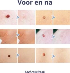 Steelwratjes Verwijderaar - Steelwratjes Verwijderen - Pijnloos En Snel - Wrattenverwijderaar - Steelwratten -Verzorgingsproducten 1148x1200