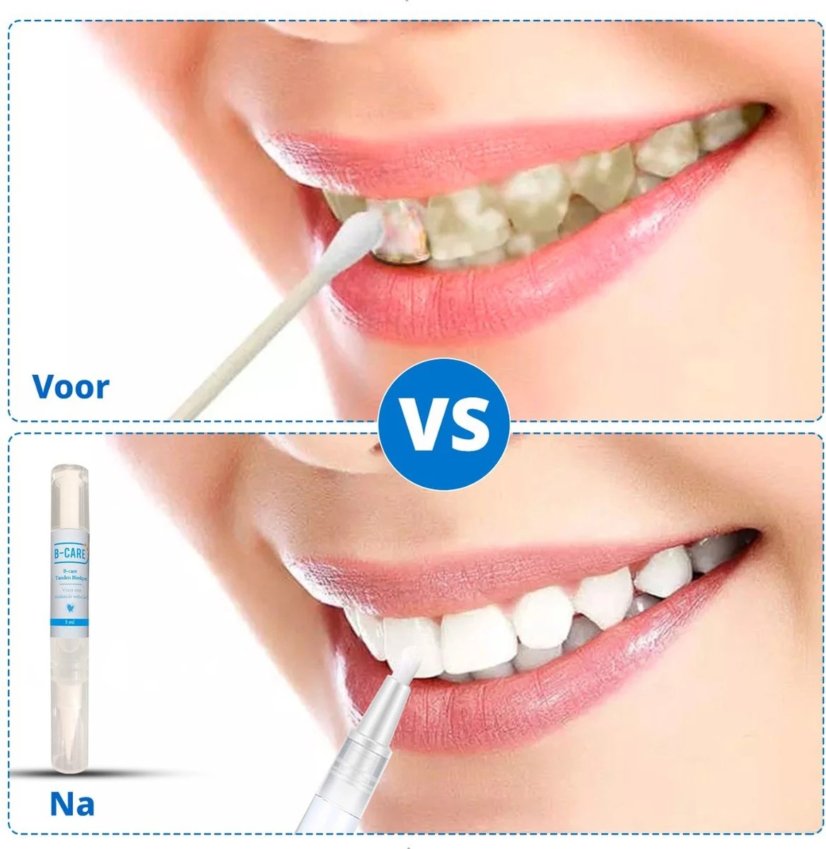 B-care Tanden Bleekpen - Teeth Whitening Pen - Tanden Bleker - Wittere Tanden - Teeth Whitening Strips - Professioneel Resultaat - Tandsteen Verwijderaar - Zonder Peroxide - Tandenbleekset - Tanden Bleken 4 B-care Tanden Bleekpen - Teeth Whitening Pen - Tanden Bleker - Wittere Tanden - Teeth Whitening Strips - Professioneel Resultaat - Tandsteen Verwijderaar - Zonder Peroxide - Tandenbleekset - Tanden Bleken - Afbeelding 2