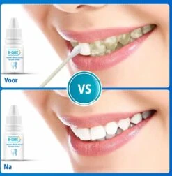 B-care Tanden Bleker – Wittere Tanden – Teeth Whitening Strips – Professioneel Resultaat - Tandsteen Verwijderaar - Zonder Peroxide - Tandenbleekset - Tanden Bleken -Verzorgingsproducten 1177x1200 9