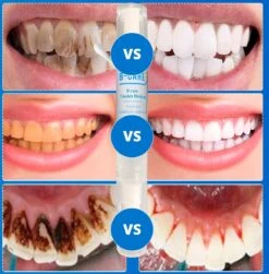 B-care Tanden Bleekpen - Teeth Whitening Pen - Tanden Bleker - Wittere Tanden - Teeth Whitening Strips - Professioneel Resultaat - Tandsteen Verwijderaar - Zonder Peroxide - Tandenbleekset - Tanden Bleken 23 B-care Tanden Bleekpen - Teeth Whitening Pen - Tanden Bleker - Wittere Tanden - Teeth Whitening Strips - Professioneel Resultaat - Tandsteen Verwijderaar - Zonder Peroxide - Tandenbleekset - Tanden Bleken -Verzorgingsproducten 1181x1200 7