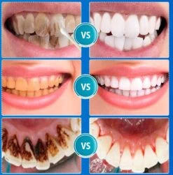 B-care Tanden Bleker – Wittere Tanden – Teeth Whitening Strips – Professioneel Resultaat - Tandsteen Verwijderaar - Zonder Peroxide - Tandenbleekset - Tanden Bleken -Verzorgingsproducten 1181x1200 8