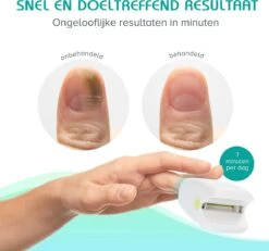 Anti Schimmelnagel Zelf-laserapparaat Incl. Pedicure Set -Verzorgingsproducten 1200x1120