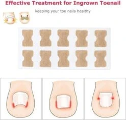 Merkloos Ingegroeide Teennagel Corrector -Verzorgingsproducten 1200x1146