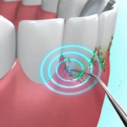 Toppers Van TV - Sonic Tandsteenverwijderaar - Tandplakverwijderaar 16 Toppers Van TV - Sonic Tandsteenverwijderaar - Tandplakverwijderaar -Verzorgingsproducten 1200x1200 1738