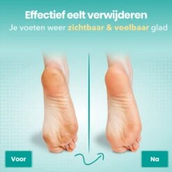 FreshDragon Elektrische Eelt Verwijderaar - Voetvijl - Inclusief 3 Rollers - Oplaadbaar -Verzorgingsproducten 1200x1200 218