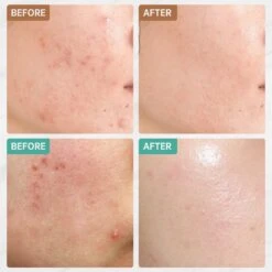 Jinius ® - Pimple Patches - Pimple Patch - Acne Patch - Puisten Verwijderaar - Puisten Pleister - Acne Pleister - Acne Sticker - Puistjes Verwijderen - 108 Stuks -Verzorgingsproducten 1200x1200 2352