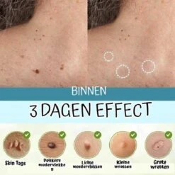 Skini™ - Moedervlekken & Wratten & Skin Tags Verwijderaar | Moedervlekken Verwijderaar | Wratten Verwijderaar | Moedervlekken Verwijderen | Wratten Verwijderen | Fibroom Verwijderen | Skin Tag Verwijderen | Steelwratjes Verwijderen 7 Skini™ - Moedervlekken & Wratten & Skin Tags Verwijderaar | Moedervlekken Verwijderaar | Wratten Verwijderaar | Moedervlekken Verwijderen | Wratten Verwijderen | Fibroom Verwijderen | Skin Tag Verwijderen | Steelwratjes Verwijderen -Verzorgingsproducten 1200x1200 642