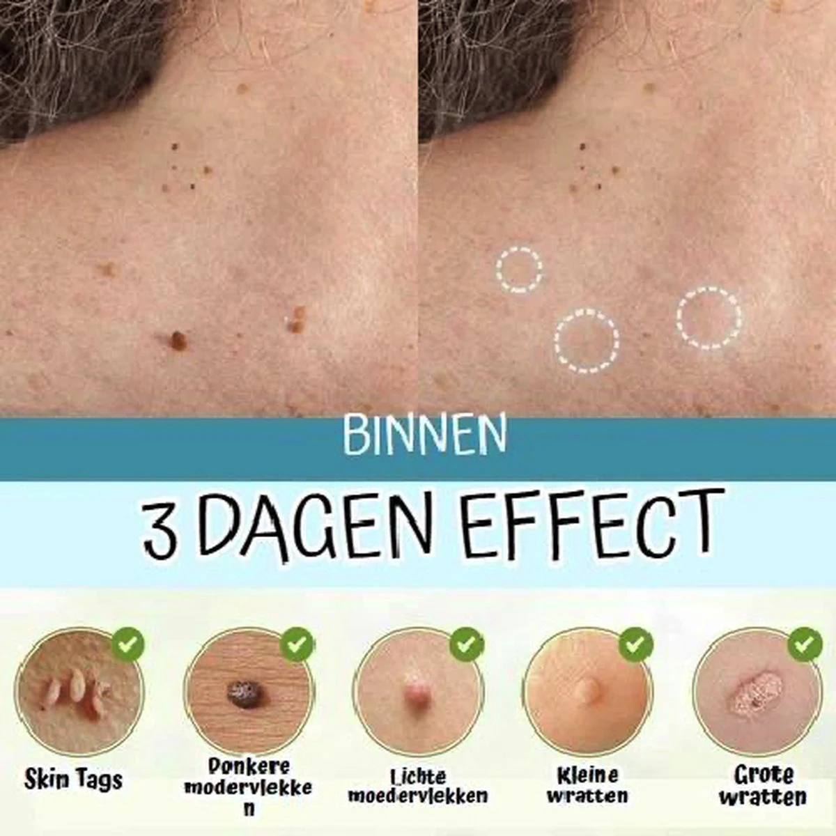 Skini™ - Moedervlekken & Wratten & Skin Tags Verwijderaar | Moedervlekken Verwijderaar | Wratten Verwijderaar | Moedervlekken Verwijderen | Wratten Verwijderen | Fibroom Verwijderen | Skin Tag Verwijderen | Steelwratjes Verwijderen 5 Skini™ - Moedervlekken & Wratten & Skin Tags Verwijderaar | Moedervlekken Verwijderaar | Wratten Verwijderaar | Moedervlekken Verwijderen | Wratten Verwijderen | Fibroom Verwijderen | Skin Tag Verwijderen | Steelwratjes Verwijderen - Afbeelding 3