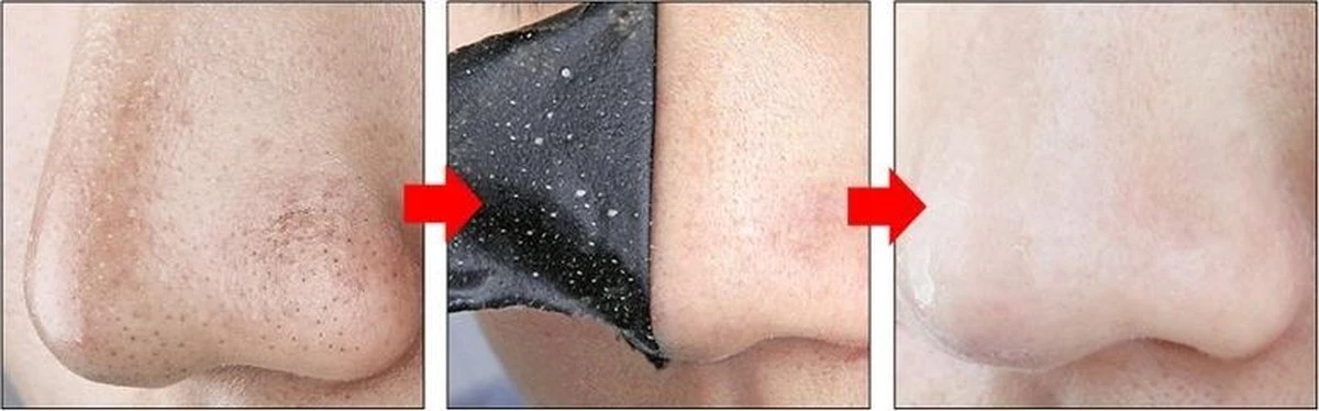 Merkloos Peel Off Mask - Mee-eters Verwijderen - Neus - 20 Strips - Neusstrip - Puistjes - Charcoal - Acne - Acne Behandeling - Diepe Reiniging - Blackhead - Poriën - Mee-eter - Verwijderen 4 Merkloos Peel Off Mask - Mee-eters Verwijderen - Neus - 20 Strips - Neusstrip - Puistjes - Charcoal - Acne - Acne Behandeling - Diepe Reiniging - Blackhead - Poriën - Mee-eter - Verwijderen - Afbeelding 2