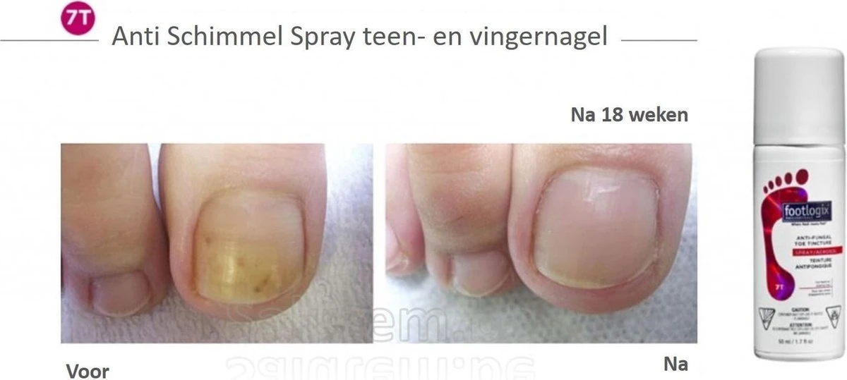 Footlogix Toe Nail Tincture Nagelspray 4 Footlogix Toe Nail Tincture Nagelspray - Afbeelding 2