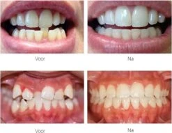 Edoir Rechte Tanden Beugel - Retainer Voor Rechte Tanden - Rechte Tanden Bitje -Verzorgingsproducten 1200x929 1